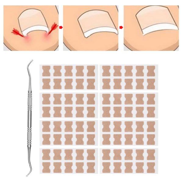 9 stk / sett Inngrodde tånegl-korreksjonsklistremerker Inngrodde tånegl-lapper Høvleverktøy