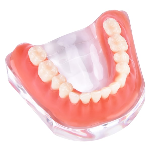 Dental Tenner Studie Modell Overdenture Tenner Inferior Precision Implant Demo