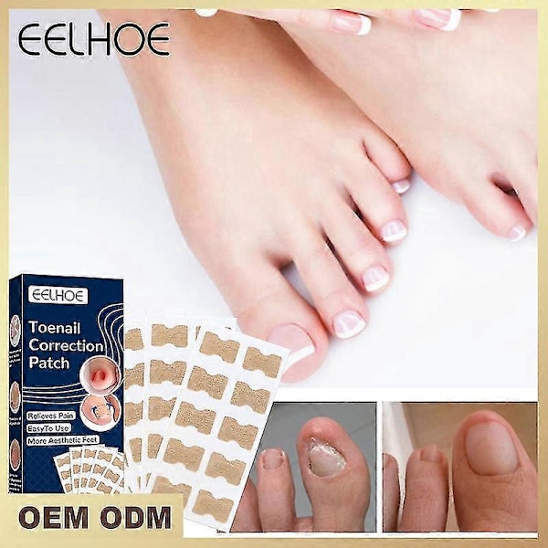 Paronychia Behandling Nagelkorrigeringsstickers - 100st