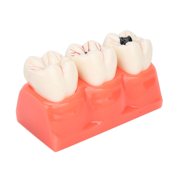 Caries model Tandforfald demonstrationsmodel Simulering aftagelig tandmodel