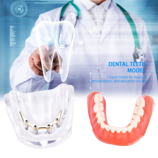 Dental Tenner Studie Modell Overdenture Tenner Inferior Precision Implant Demo