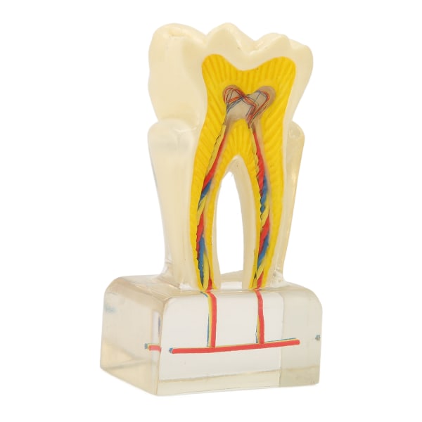Caries model akryl 6 gange forfalden tand model Tanduddannelsesartikler til tandlæger Undervisning
