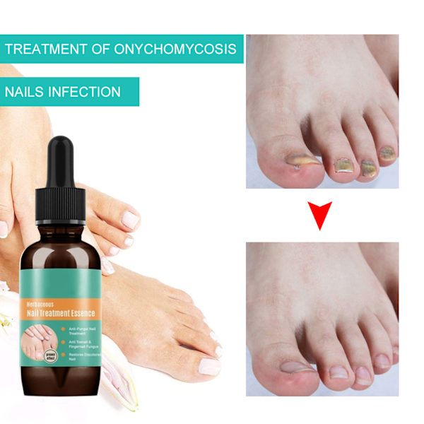 30ml Nail Fungal Liquid Anti Fungal Nail Solution for finger- og tånegler