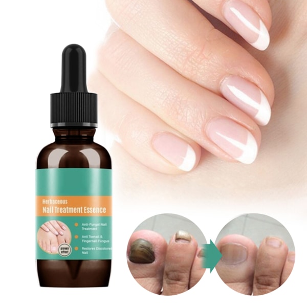 30ml Nail Fungal Liquid Anti Fungal Nail Solution for finger- og tånegler