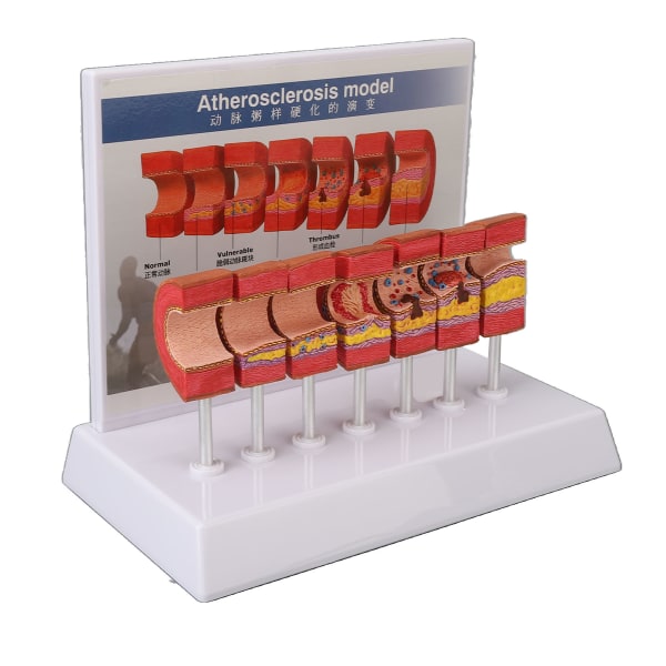 7st Artäranatomimodell Anatomisk kärl Ateroskleros Tromb Vaskulär modell för läkare Utbildningsverktyg för kontoret