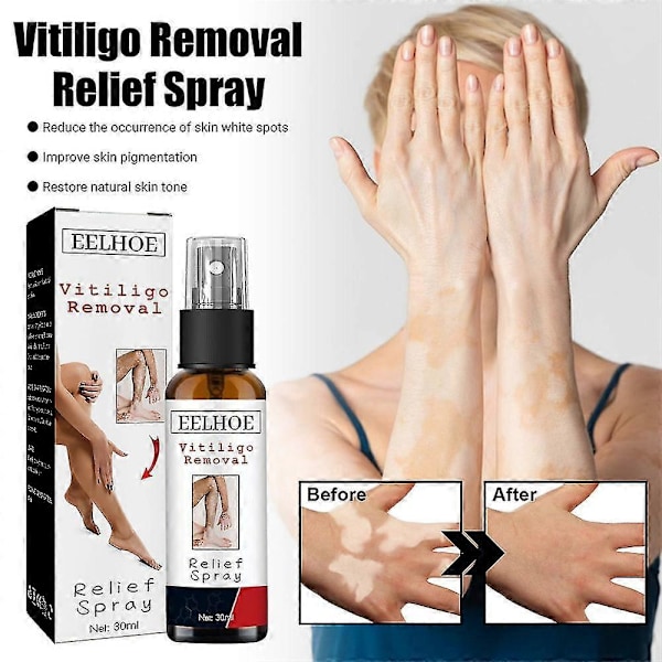 Vitiligo Behandlingsspray til Hud - Reducerer Hvide Pletter - 3 stk.
