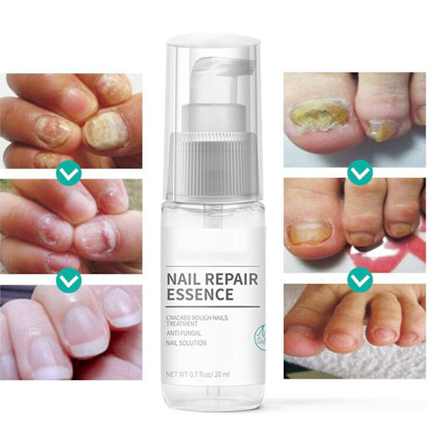 Neglepleje flydende eksfoliering Forbedrer revnede ru negle Reparationsgel til fingernegl tånegl 20ml