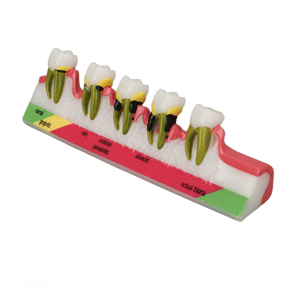 Teeth Periodontal Disease Model Ulike stadier Resin Dental Periodontitis Display Model