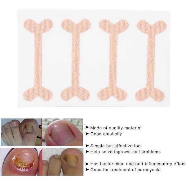 Tåneglskorrigeringssticker, 24 stk. - Effektiv behandling av paronyki med bånd for fotpleieverktøy, smertelindring