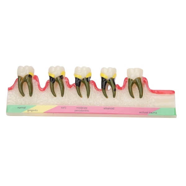 Hammashoidon periodontaalisen sairauden malli Hammastautien tutkimuksen opetusmalli hammaslääkärikoululle