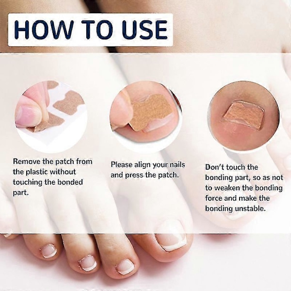 Paronychia Behandling Nagelkorrigeringsstickers - 100st