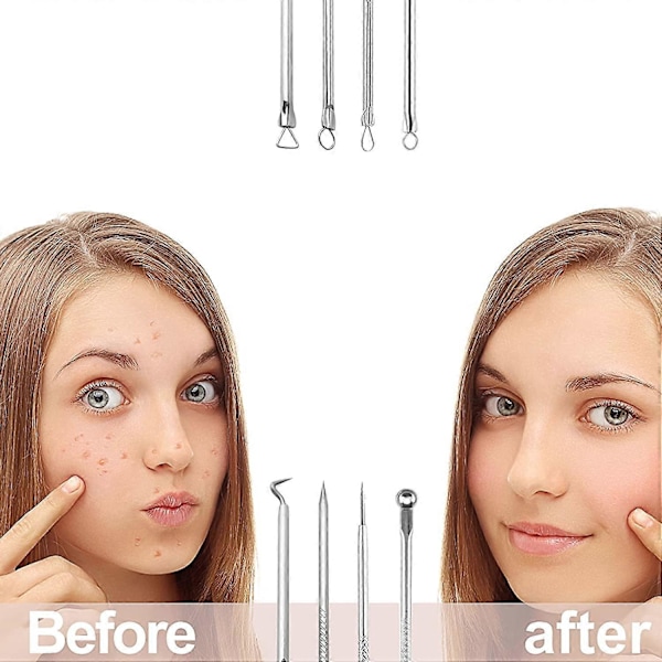 d'outils de nettoyage de points noirs, 4 pices professionnelles en acier inoxydable, extracteur de brlures et comdons, pour le soin du visage avec tui
