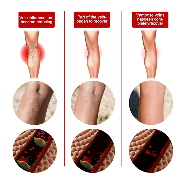 Åreknudespray Antiinflammatorisk Effektiv Åreknudespray