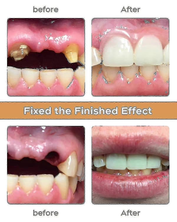 DIY Denture Repair Kit for Missing Teeth Easy Convenient Sn319