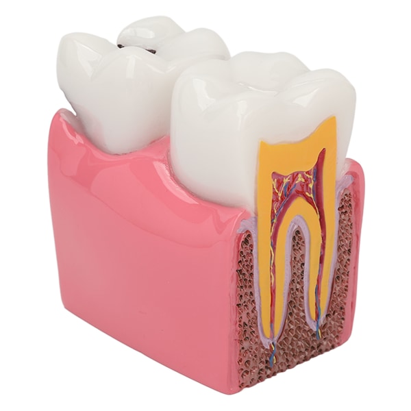 Dental karies modell tand 6X förfall demonstrationsmodell för undervisning i studielaboratorier