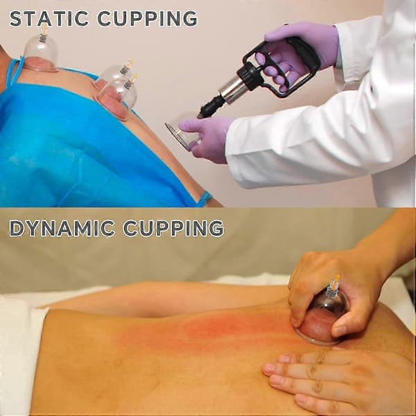 Cupping Terapi Sæt m/ 12 Massagekopper til Lindring af Rygsmerter Fysioterapi med Håndpumpe (Hvid Håndpumpe, 12 KOpper)