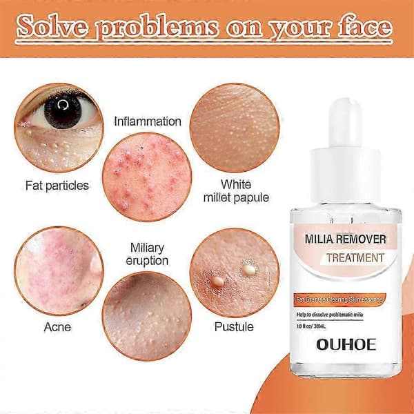 Miliafjerner - Opløs og reducer milia, hudorme, talgkirtelhyperplasi - 30 ml